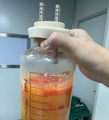 湖北水动力吸脂手术要做多久？